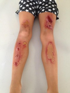 Blisters and Lime Burns